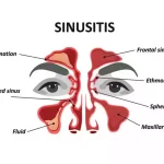 sinusitis