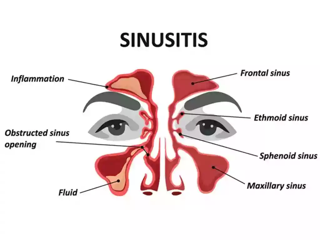 sinusitis